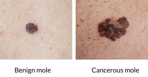 Skin Cancer Moles Signs