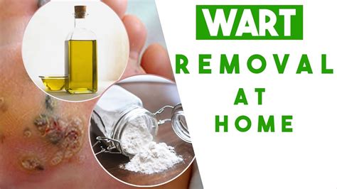 The BEST Wart Removal at Home - 100% Safe & Natural - YouTube