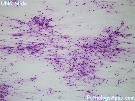 pilocytic astrocytoma pathology