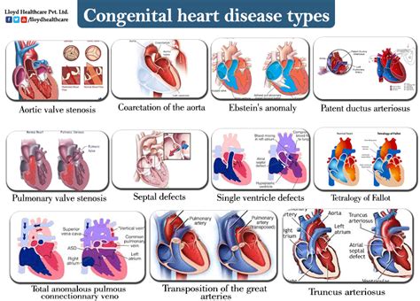 heart disease - Congenital Heart Defect