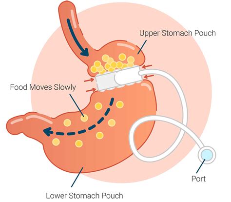 How Much Is A Gastric Band - The stomach is not cut but it is a more ...