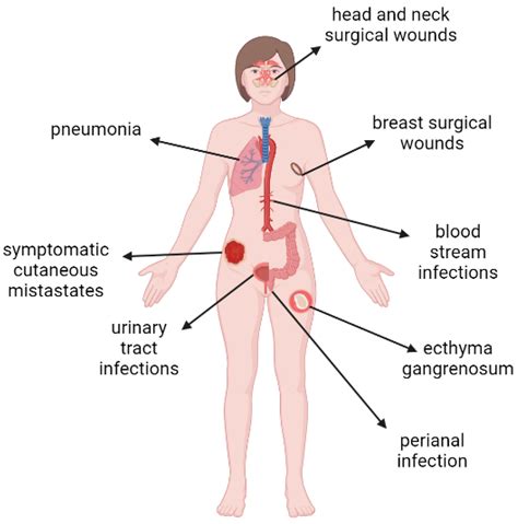 Pathogens | Free Full-Text | Pseudomonas aeruginosa Infections in ...