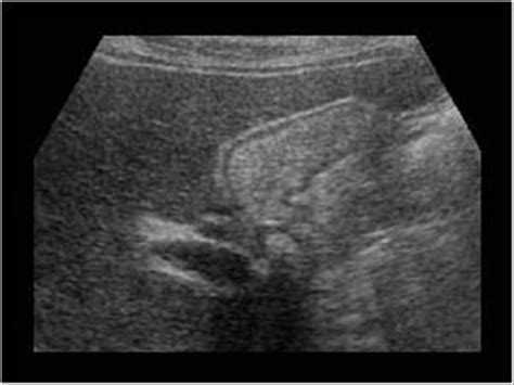 Abdomen and retroperitoneum | 1.2 Gallbladder and bile ducts : Case 1.2 ...