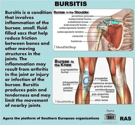 28 best Bursitis images on Pinterest | Physical therapy, Bursitis hip ...