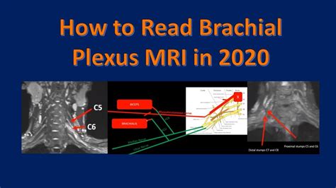 Brachial Plexus Anatomy Mri