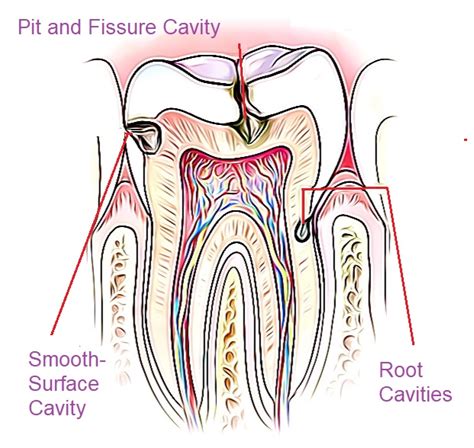 three-different-cavity-types – Archer Dental