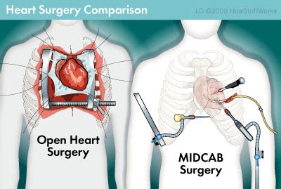 Is a Bypass Open Heart Surgery | Heart Surgery Information