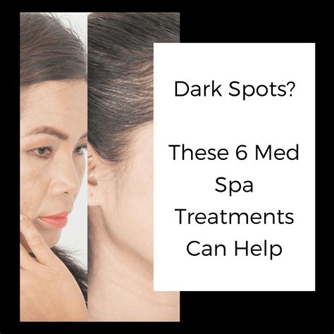 Dark Spots? These 6 Med Spa Treatments can help - Elan Skin and Laser