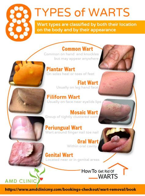 How To Get Rid Of Gentile Warts - Religionisland Doralutz