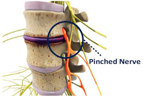 Pinched Nerve In Neck Exercises - All You Need Infos