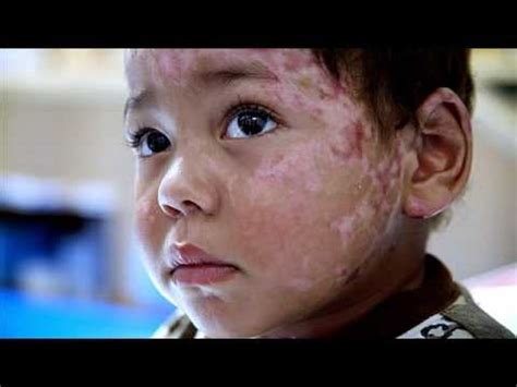 Brother Burn Victims Playing Like Kids Again - YouTube