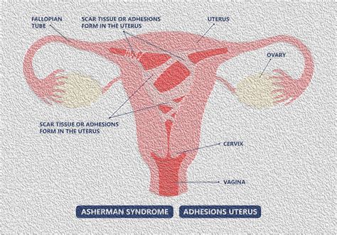 Endometrial Scarring/Adhesions - Asherman’s Syndrome - Dr Eleftherios ...