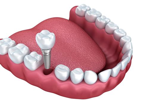 Types of Dental Implants Claremont CA | Teeth Implants