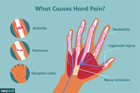 38+ Diagram Of Hand Pain - ArifaAnshuka