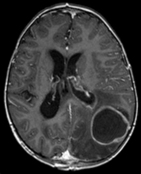 Bacterial, Viral and Fungal Infections of the CNS | Lecturio