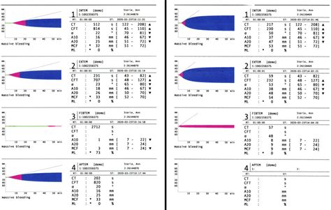 ROTEM results. Rotational thromboelastometry (ROTEM) results ...