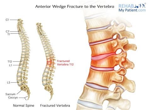 Anterior Wedge Fracture to the Vertebra | Rehab My Patient Vertebrae ...