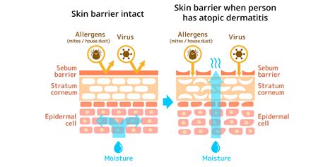 Eczema types: Atopic dermatitis causes