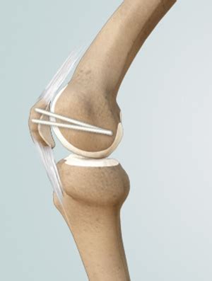 Medial Patellofemoral Ligament Injury San Marcos, TX | MPFL ...