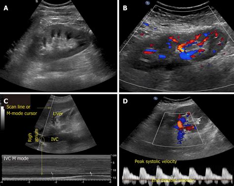 Normal Kidney Ultrasound