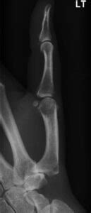 Osteoarthritis of the thumb - Dorset Hand Surgery