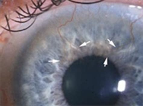 Treatment of Corneal Vascularization | ophthalmologyweb.com