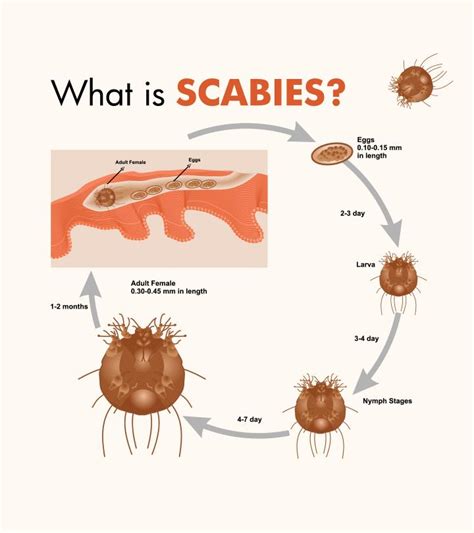 Scabies In Kids: Causes, Symptoms, Diagnosis And Treatment