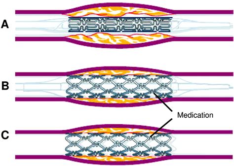 サイズ Drug‐eluting stent ぐるぐる王国 PayPayモール店 - 通販 - PayPayモール ページ