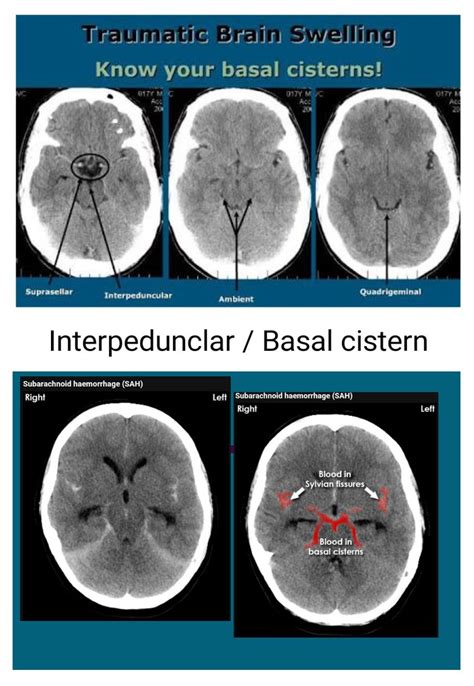 Interpedunclar / Basal cistern | Radiology imaging, Medical knowledge ...