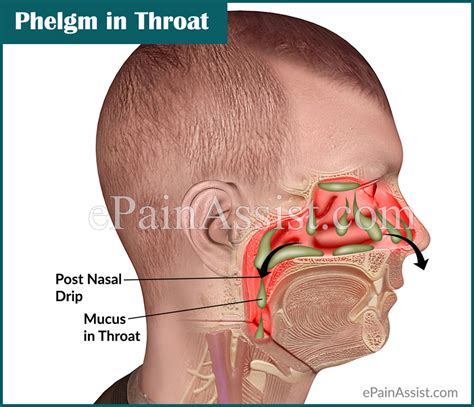 Phlegm in Throat or Mucus in Throat: Causes & Ways to Get Rid of it!