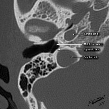 Jugular Foramen Mri