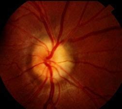 Optic Nerve Drusen - American Association for Pediatric Ophthalmology ...