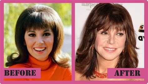 Marlo Thomas Plastic Surgery - Did She Have It?