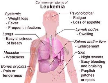 Diagram Of Blood Cancer Symptoms Image - Graph Diagram