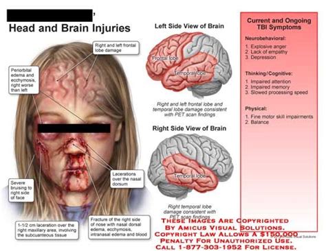 Frontal Lobe Brain Injury. | Brain injury, Brain injury awareness ...