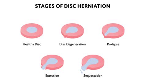 Treating an L5-S1 Disc Herniation: A Case Study - Regenexx