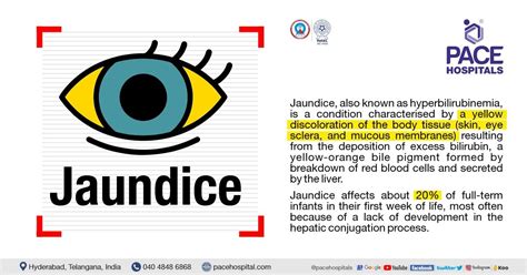 Jaundice Disease - Symptoms, Causes, Complications and Prevention