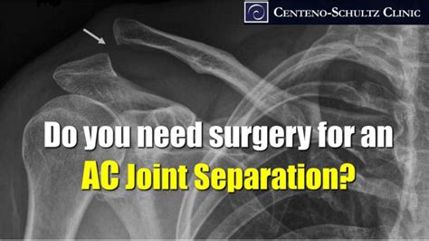 Shoulder AC Joint Separation? Think Twice About Surgery