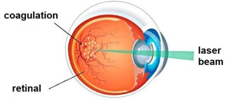 Laser Treatment (Photocoagulation) - Aravind Eye Care System