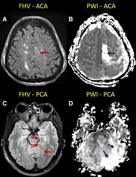 Estimating Perfusion Deficits in Acute Stroke Patients Without ...