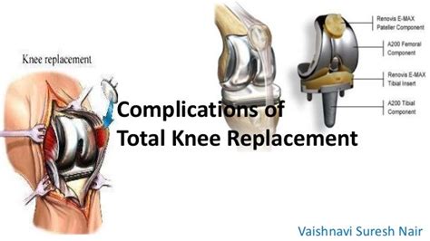 Complications of total knee replacement