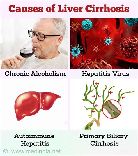 Liver Cirrhosis - Causes, Symptoms, Diagnosis, Treatment & Prevention