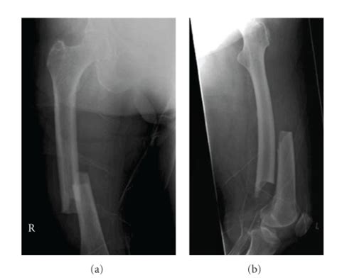 A case of bilateral femur fractures in a patient who had been on ...