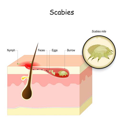 Scabies: Causes, Rash Signs & Treatment Options