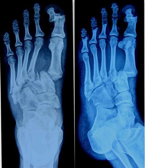 dislocation | The Foot and Ankle Online Journal