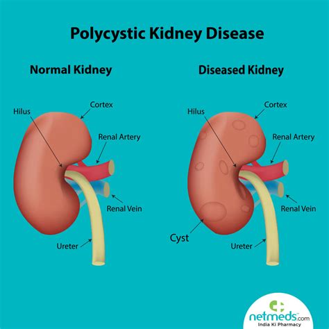 Polycystic kidney disease: Causes, Symptoms And Treatment