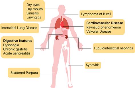 Frontiers | Pathogenesis and treatment of Sjogren’s syndrome: Review ...