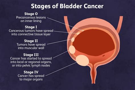 Stages of Bladder Cancer: What You Need to Know