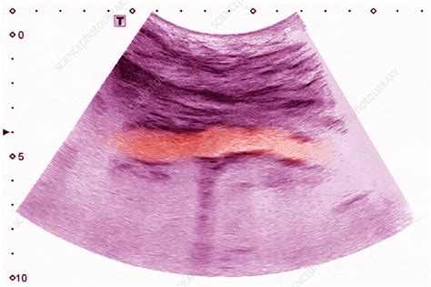 Calcific aortic atheroma, ultrasound - Stock Image - C030/6260 ...