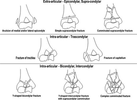 Figure 12.8 Distal humeral fracture classification system. One fracture ...